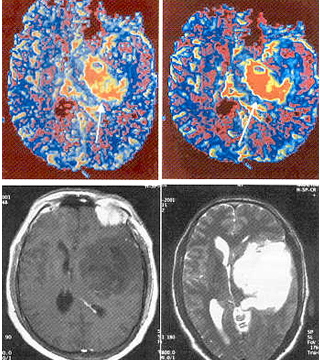 Magnetic Resonance Perfusion Imaging