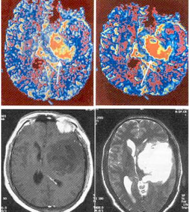 Magnetic Resonance Perfusion Imaging